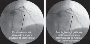 Angiograma coronário diagnóstico obtido na última admissão hospitalar. Observa-se intenso espasmo coronário da descendente anterior média, que é solucionado com administração de nitratos por via intracoronária.