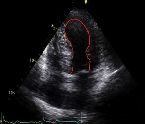Ecocardiograma transtorácico, apical 4 câmaras, com ectasia e acinésia apical e dos segmentos médios do ventrículo esquerdo. A linha vermelha contorna o endocárdio cardíaco e define uma linha que se assemelha ao contorno de um takotsubo, isto é, vaso com que se capturava o polvo na pesca.