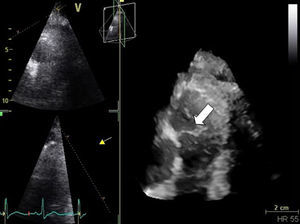 Three-dimensional view of pulmonary valve; vegetation is indicated by the white arrow.