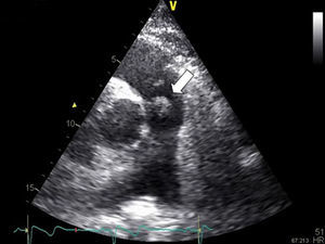 Short-axis view of vegetation on pulmonary valve after 6 weeks of antibiotic therapy, indicated by the white arrow.