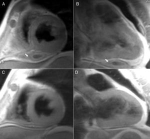Panels A and B: short- and long-axis views, T1: double IR with contrast sequence; panels C and D: short- and long-axis views, T1: double IR with contrast sequence.