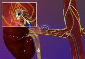 Aplicação de energia de radiofrequência nas artérias renais, para ablação da atividade simpática aferente e eferente.
