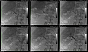 Pontos de aplicação de radiofrequência na artéria renal direita.