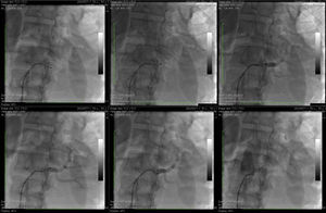 Pontos de aplicação de radiofrequência na artéria renal esquerda.