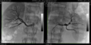 Angiografia renal final após aplicações de radiofrequência.