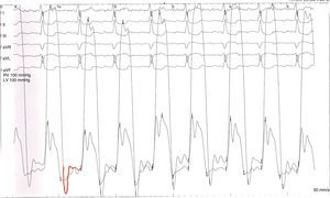 Gráfico de pressões ventriculares, com a imagem dip-plateau do ventrículo esquerdo (VE).