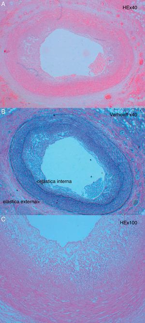 Imagens histológicas de lesões típicas da DVA com proliferação concêntrica da íntima (A e B). Na figura C é possível observar a presença de numerosas células inflamatórias na lesão.