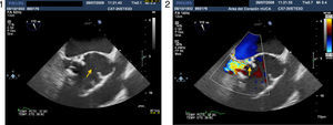 Transesophageal echocardiography showing severe dilatation of the aortic root (arrow) and severe aortic regurgitation (arrow).