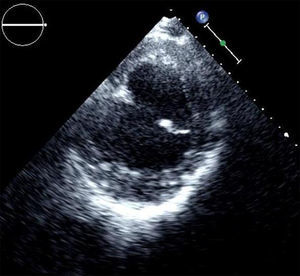 Ecocardiograma transtorácico. Eixo curto do ventrículo esquerdo, com imagem de volumosa formação aneurismática em localização póstero-inferior.