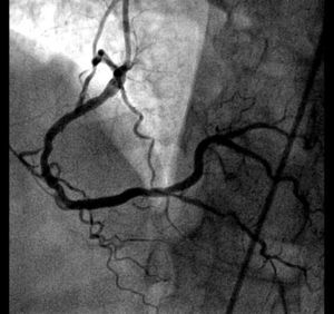 Posterior descending artery with 70% stenosis.