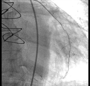 Patent left descending-left internal mammary artery bypass.