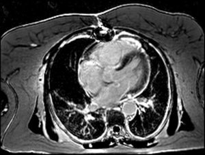 Right ventricular dilatation and transmural late enhancement of the mid-apical segments of the right ventricle.