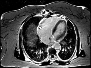 Absence of left ventricular late enhancement.