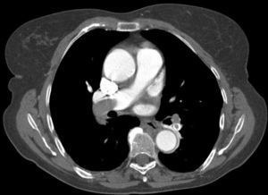Êmbolo na artéria pulmonar direita e lobo inferior esquerdo.