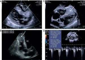 (A-D) Ecocardiograma transtorácico, mostrando a presença de massa infiltrativa ao nível do VD (seta), envolvendo toda a região apical, septo interventricular e parede livre do VD, não condicionando obstrução significativa ao nível da câmara de saída do VD (2D). AD: aurícula direita; AE: aurícula esquerda; SIV: septo interventricular; VD: ventrículo direito; VE: ventrículo esquerdo.