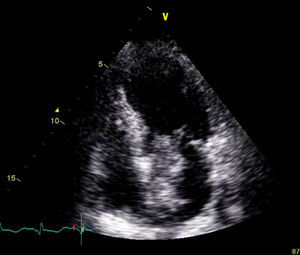 Imagem de ecocardiografia bidimensional transtorácica em plano apical 4C, mostrando a volumosa e irregular massa auricular esquerda, fixada ao septo interauricular.