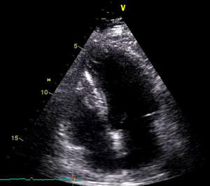 Imagem de ecocardiografia bidimensional transtorácica em plano apical 4C, após ressecção do mixoma.