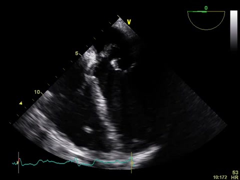 An atypical presentation of infective endocarditis | Revista Portuguesa ...