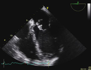 Transesophageal echocardiography showing large vegetations on the anterior mitral valve leaflet.