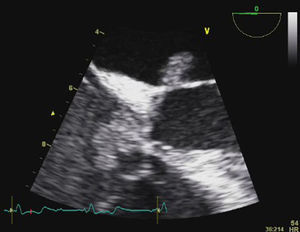 Transesophageal echocardiography: detail of anterior mitral valve leaflet vegetation, and extension to the mitral-aortic junction and septal tricuspid leaflet.