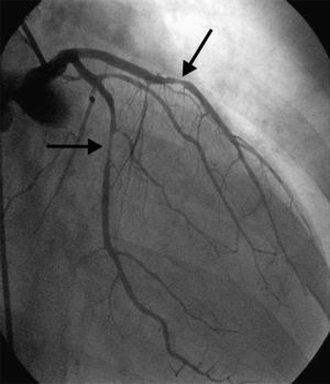 Coronary angiogram of the left coronary system in right anterior oblique projection demonstrating spasm of the mid left anterior descending artery (top black arrow) and the distal left circumflex artery (bottom black arrow).
