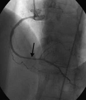 Coronary angiogram of the right coronary system in left anterior oblique projection demonstrating spasm of the distal right coronary artery (black arrow).