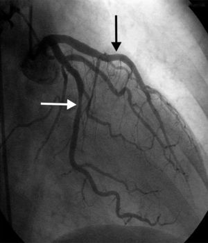 Coronary angiogram of the left coronary system in right anterior oblique projection demonstrating resolution of spasm of the mid left anterior descending artery (top white arrow) and improvement in the spasm of the distal left circumflex artery (bottom white arrow) with residual stenosis.