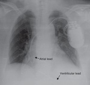 Initial chest X-ray after defibrillator implantation.