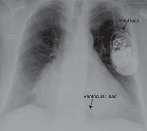 Chest X-ray showing displacement of both leads.
