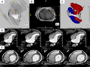 Multidetector computed tomography post-processed volume rendered images (A, B and C) showing the thickened and calcified pericardium and its relations with the coronary arteries and cardiac chambers. Maximum intensity projection images in long- (D) and short-axis (E) views in different phases of the cardiac cycle illustrate restricted myocardial movement and diastolic apical dilatation. Tube current modulation was used to reduce radiation exposure, with full current applied only in diastolic phases (note differences in image quality in systole and diastole).