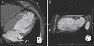 Cardiac computed tomography scan for device sizing and accurate evaluation of left ventricular apex anatomy and left ventricular morphology.