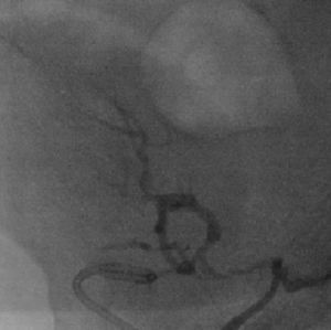 Angiografia demonstrando hipoperfusão do enxerto renal, com visualização de imagens de subtração, heterogéneas e difusas na artéria renal, sugestivas de trombos organizados.