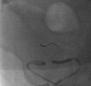 Angioplastia com balão da artéria renal do enxerto.