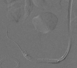 Implantação de stent na artéria renal do enxerto.