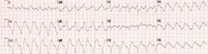 Eletrocardiograma que revela taquicardia ventricular não mantida com uma frequência cardíaca de 180 b.p.m.