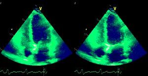 Ecocardiograma na incidência apical 4 câmaras em telediástole (esquerda) e telessístole (direita): disfunção grave do VE.