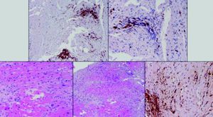 Fragmentos de biópsia endomiocárdica revelando infiltrado linfocitário.