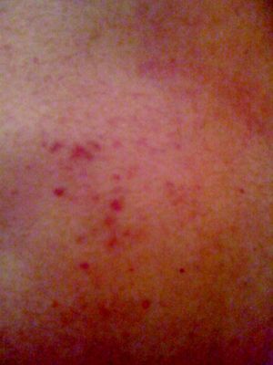 Lesões cutâneas dorsais tipo púrpura.