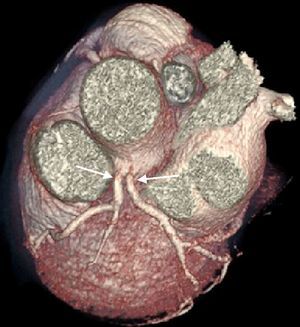 Ausência de tronco comum, descendente anterior e circunflexa com óstios separados em reconstrução 3D volume rendered.