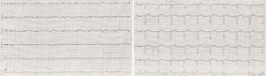 Electrocardiography at presentation. Complete heart block with wide QRS escape rhythm (left bundle branch block aberration, 59bpm).