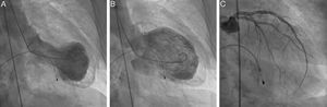 Results of cardiac catheterization. Left ventriculography at end-systole (A) and end-diastole (B) demonstrating typical apical ballooning and double outline apex suggestive of apical thrombus. Results of selective coronary angiography of the left main coronary artery (C) showing no significant stenosis.