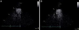 Contrast echocardiography. Left ventricle at end-systole (A) and end-diastole (B) in apical 4-chamber view, showing typical “apical ballooning” and apical thrombus.