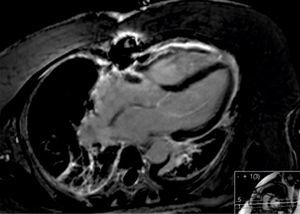 Cardiac magnetic resonance imaging in 4-chamber view showing absence of apical thrombus or delayed enhancement.