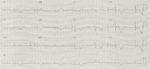 Electrocardiography two weeks after presentation: sustained complete heart block (QRS escape rhythm without left bundle branch block aberration) and evolutionary changes in T-wave morphology with inversion and QTc prolongation.