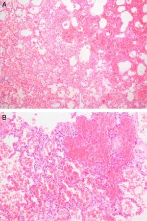 Low (A) and intermediate (B) magnification of pulmonary parenchyma with vascular congestion and multiple foci of alveolar hemorrhage, without associated inflammation.