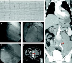 (Panel A) Electrocardiogram showing ST-segment elevation in leads V1–V4 compatible with an anterior myocardial infarction. (Panel B) Coronary angiography showing acute stent thrombosis in the proximal segment of the anterior descending coronary artery. (Panel C) Coronary angiography after thrombus aspiration showing reestablishment of TIMI 3 flow in the anterior descending coronary artery. (Panel D) Aortography revealing an abdominal aneurysm with slow flow and subtraction images suggestive of thrombus (white arrow). (Panels E and F) Computed tomography imaging showing a ruptured abdominal aneurysm (white arrow) surrounded by a large retroperitoneal hematoma (red arrow).