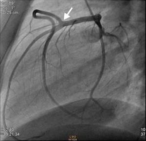 Angiografia coronária, incidência de perfil: origem anómala da artéria Coronária Direita no segmento médio da artéria descendente anterior (seta). Ausência de lesões angiograficamente significativas.
