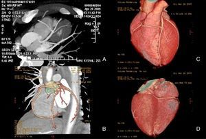 Imagens de TC cardíaca-64 cortes. As imagens A (imagem reconstruida tipo MIP) e B (imagem reconstruída tipo «volume rendering») evidenciam a origem da CD anómala no segmento médio da DA; Note-se, nas imagem C (imagem reconstruída tipo «volume rendering»), o trajeto da CD anterior aos grandes vasos e na imagem D (imagem reconstruída tipo «volume rendering»), a escassez de suprimento arterial epicárdico posterior e inferior por ausência de artérias póstero-lateral e descendente posterior.