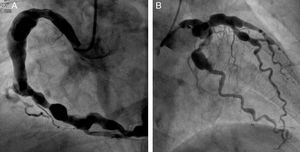 Right and left coronary angiography showing severe diffuse aneurysmal coronary artery disease. (A) Selective right coronary angiogram in left anterior oblique view showing a large aneurysm involving the proximal and mid segments of the right coronary artery (maximum diameter 12mm) as well as multiple smaller aneurysms in the distal segment of the vessel and in the posterolateral branch. (B) Selective left coronary angiogram in right anterior oblique view showing multiple aneurysms involving the distal portion of the left main coronary artery (LMCA), the proximal and mid segments of the left anterior descending (LAD) coronary artery and the proximal segment of the circumflex and the marginal branch.