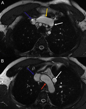A. Plano axial (b-SSFP): seta azul: veia cava superior; seta amarela: veia inominada; seta branca: veia pulmonar anómala vertical. B. Plano axial (b-SSFP); seta azul: veia cava superior; seta vermelha: arco aórtico; seta branca: veia pulmonar anómala vertical.